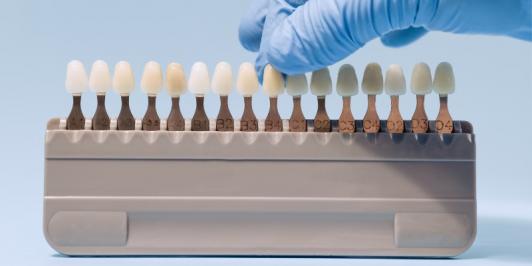 Pose de facettes Pose de facettes